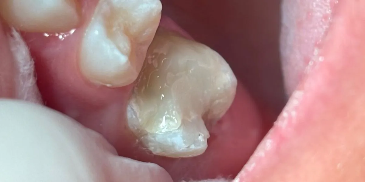 Caso 1, antes: dente posterior antes do tratamento odontológico