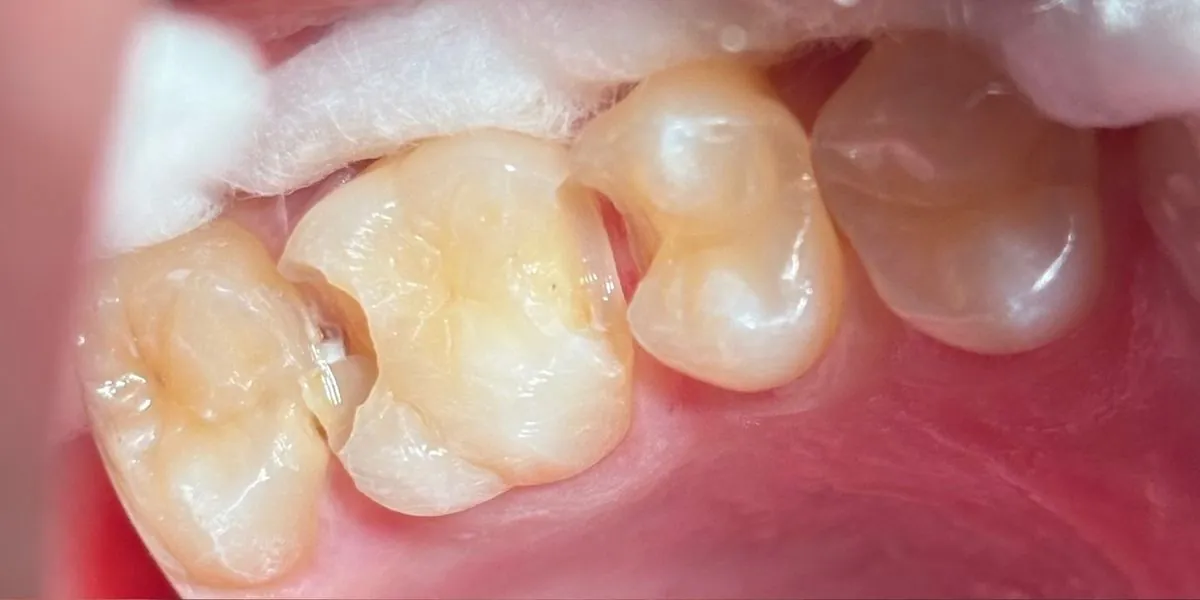 Caso 2, antes: dentes posteriores antes do tratamento odontológico