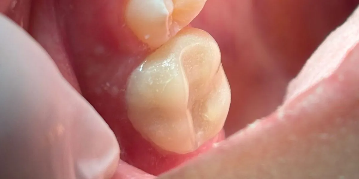 Caso 1, depois: dente posterior após o tratamento com a Dra. Mariana Pinotti, dentista em Primavera do Leste – MT