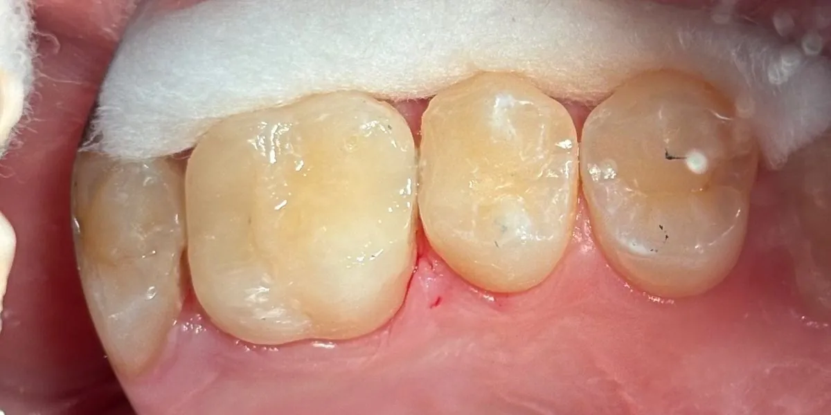 Caso 2, depois: dentes posteriores após o tratamento com a Dra. Mariana Pinotti, dentista em Primavera do Leste – MT